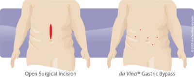 Gastric Bypass da Vinci robotic surgery at Sunrise Hospital las Vegas