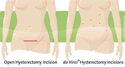 Robotic surgery hysterectomy at Sunrise Hospital Las Vegas