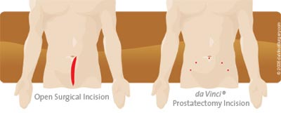 Robotic surgery prostatectomy at Sunrise Hospital Las Vegas