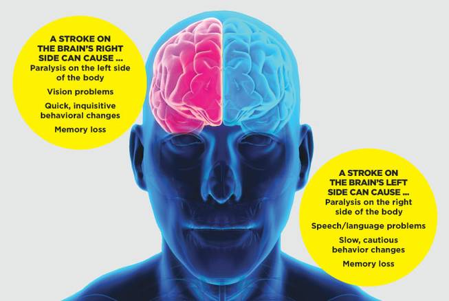 How a Stroke In The Right brain Affects The Body & How to Recover